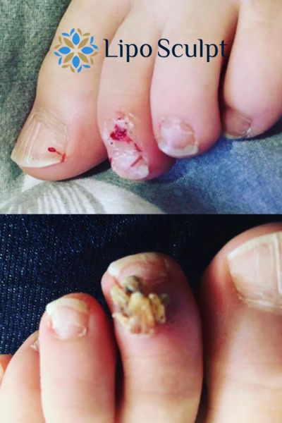 Wart removal customer results from Lipo Sculpt Soho